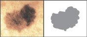dermatology_melanoma_assymetry