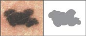 dermatology_melanoma_border