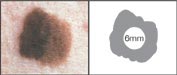 dermatology_melanoma_diameter