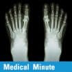 Medical Minute: Morton’s Neuroma