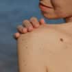 Concerned Your Mole Could Be Melanoma?