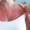 How to Best Heal a Sunburn