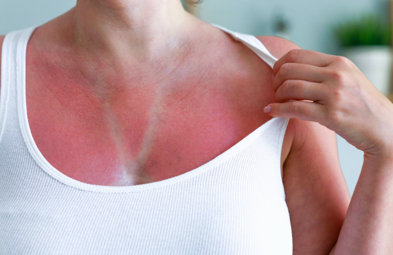 How to Best Heal a Sunburn
